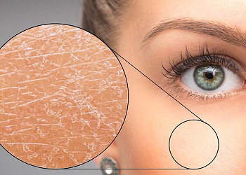 What is microdermabrasion?